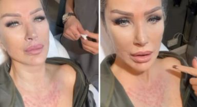 Seda Sayan, sünnet derisinden elde edilen sıvıyı yüzüne enjekte ettirdi