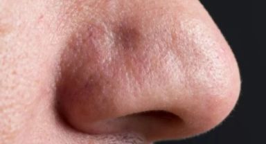 Burun ağrısı şikayeti ile hastaneye giden adamın burnundan 150 böcek çıktı