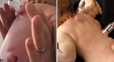 İstanbul'da Skandal Uygulama: Bebeklere Aşı Yerine Hacamat Yapıldığı İddiasıyla Soruşturma Başlatıldı