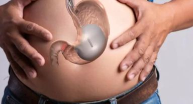 Mide Balonu Nedir?