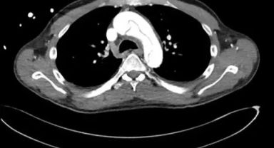 59 Yaşındaki Adam Mastürbasyon Sırasında Aort Damarı Yırttı: İlginç ve Tehlikeli Bir Vaka